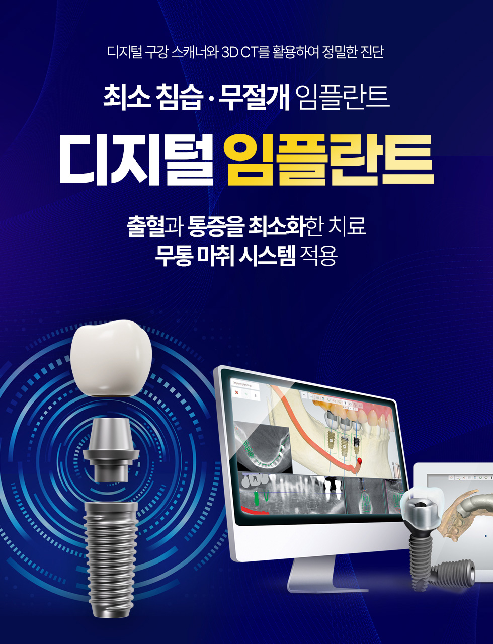 서울케이플란트치과 디지털 임플란트 최소침습 무절개 임플란트