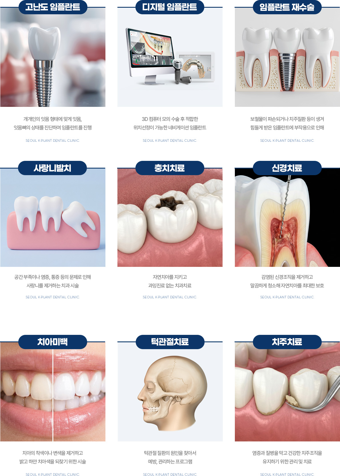 서울케이플란트치과 진료과목 고난도 임플란트 디지털 임플란트 사랑니발치 충치치료 신경치료 치주치료
