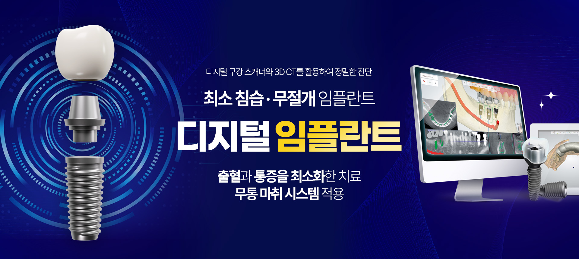 서울케이플란트치과 디지털 임플란트 최소침습 무절개 임플란트